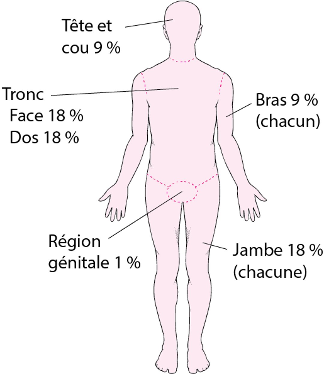 Évaluation de l’étendue d’une brûlure