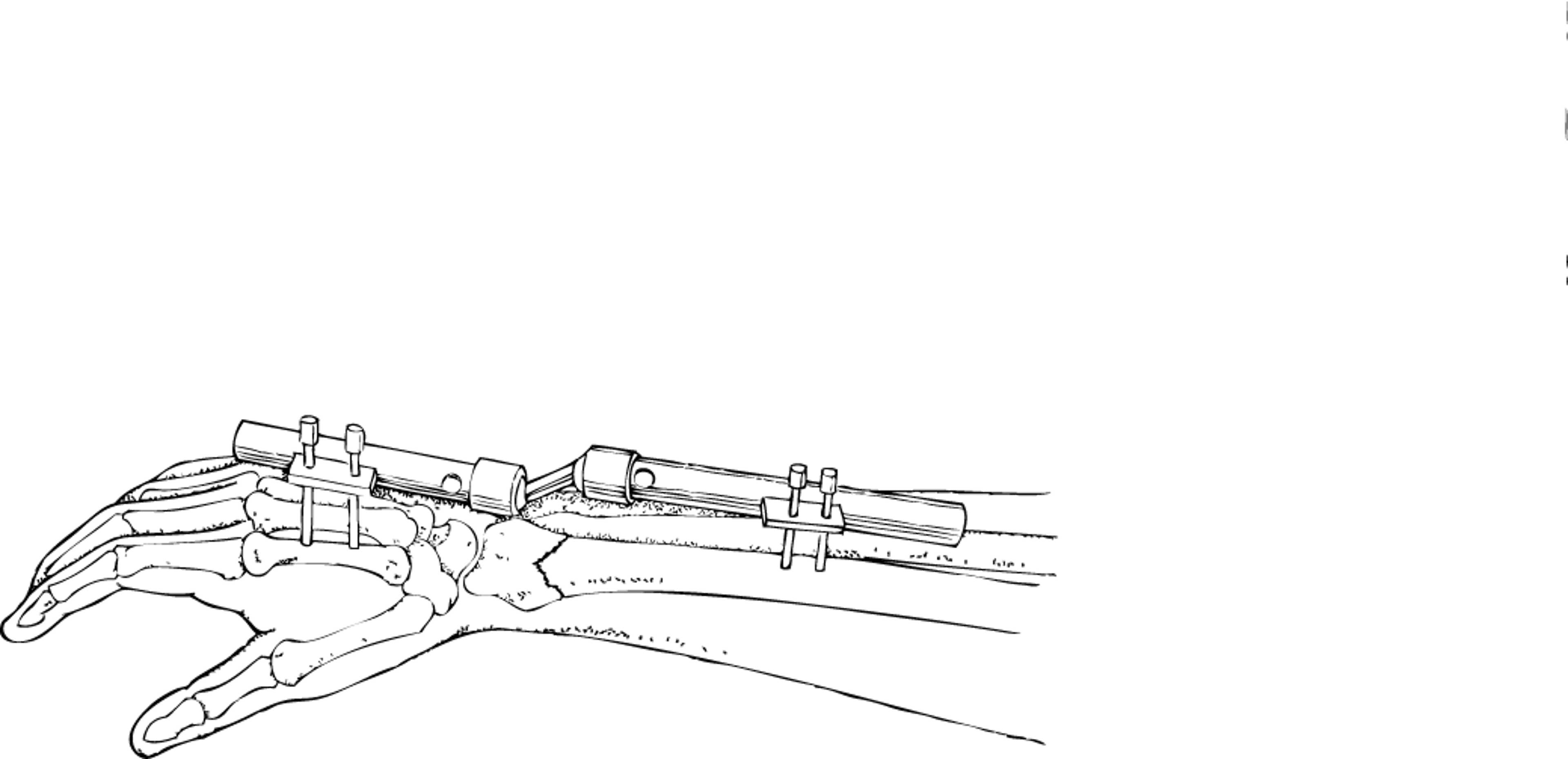 المُثَبِّت الخارجي