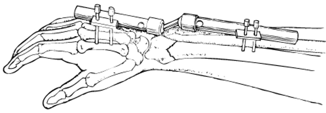एक्सटर्नल फ़िक्सेटर