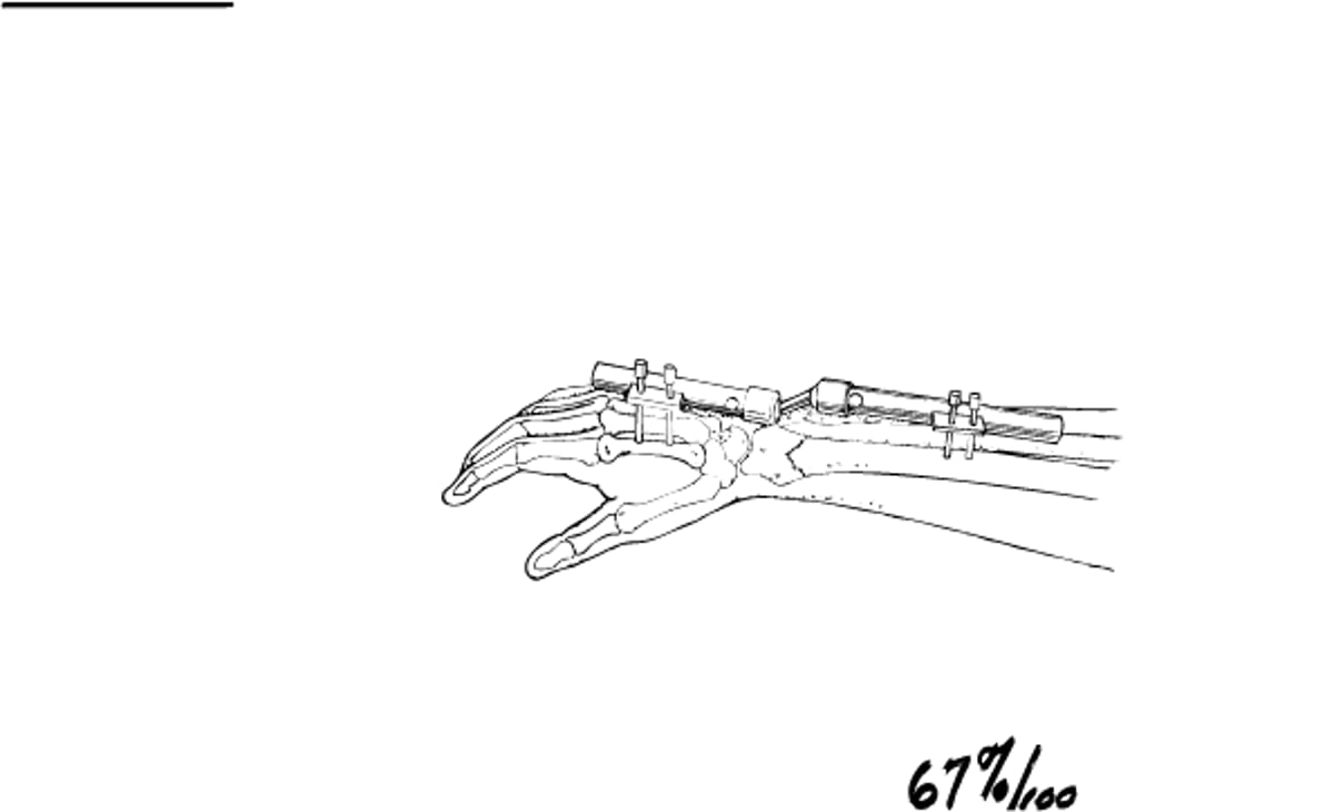 <ruby >創外固定器<rt >そうがいこていき</rt></ruby>