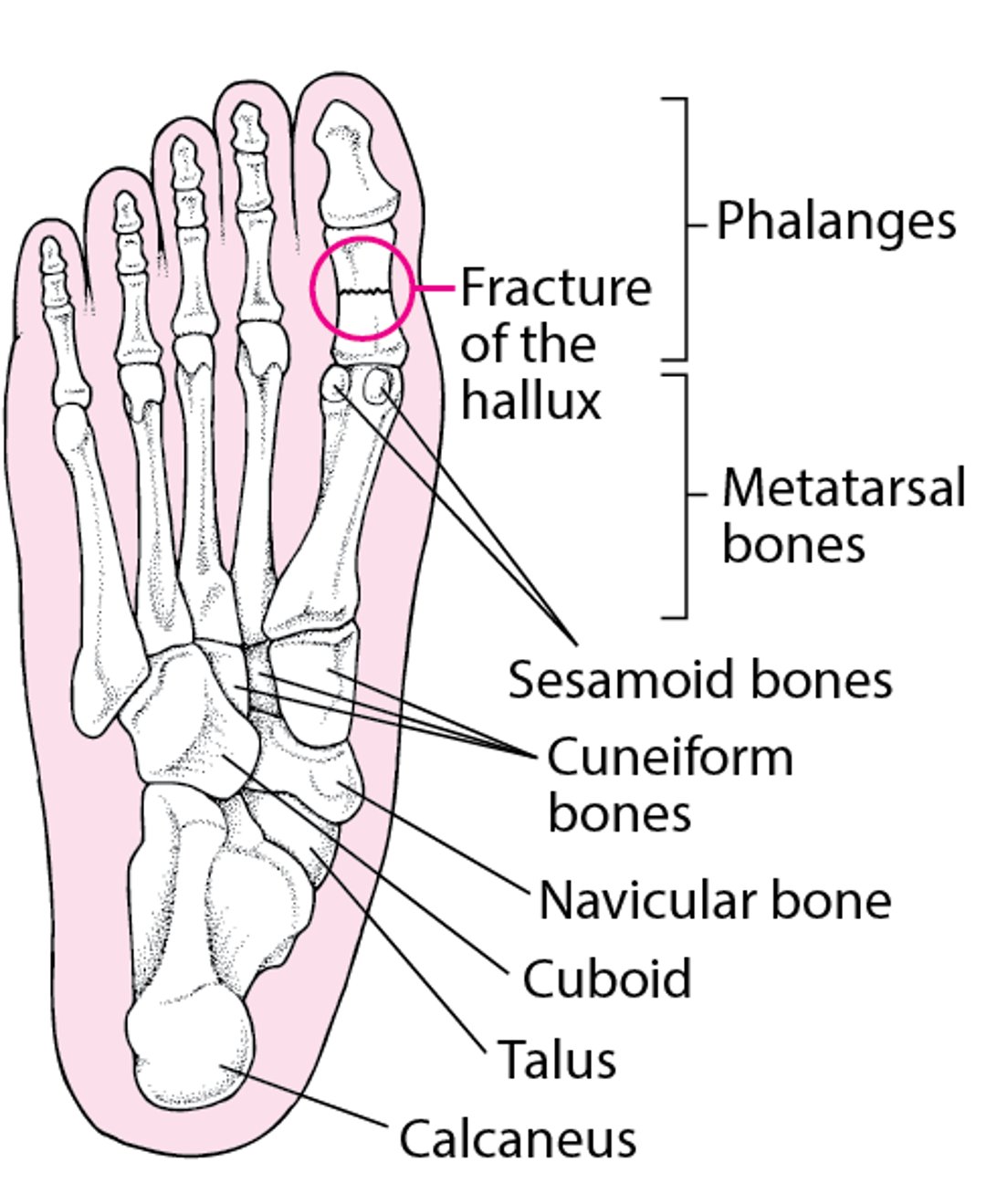 Where Foot Fractures Occur