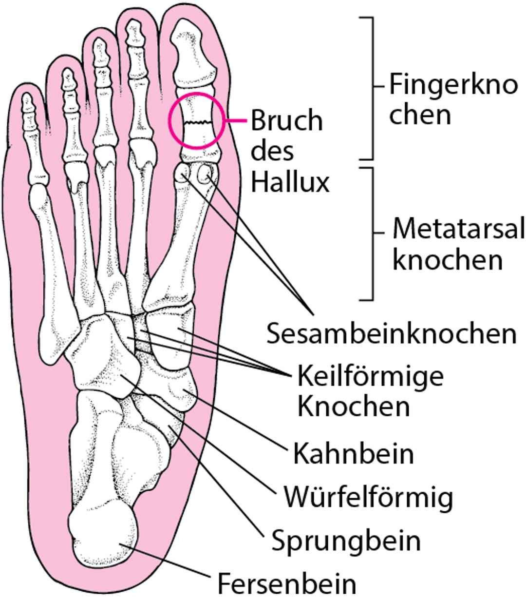 Wo Fußfrakturen auftreten