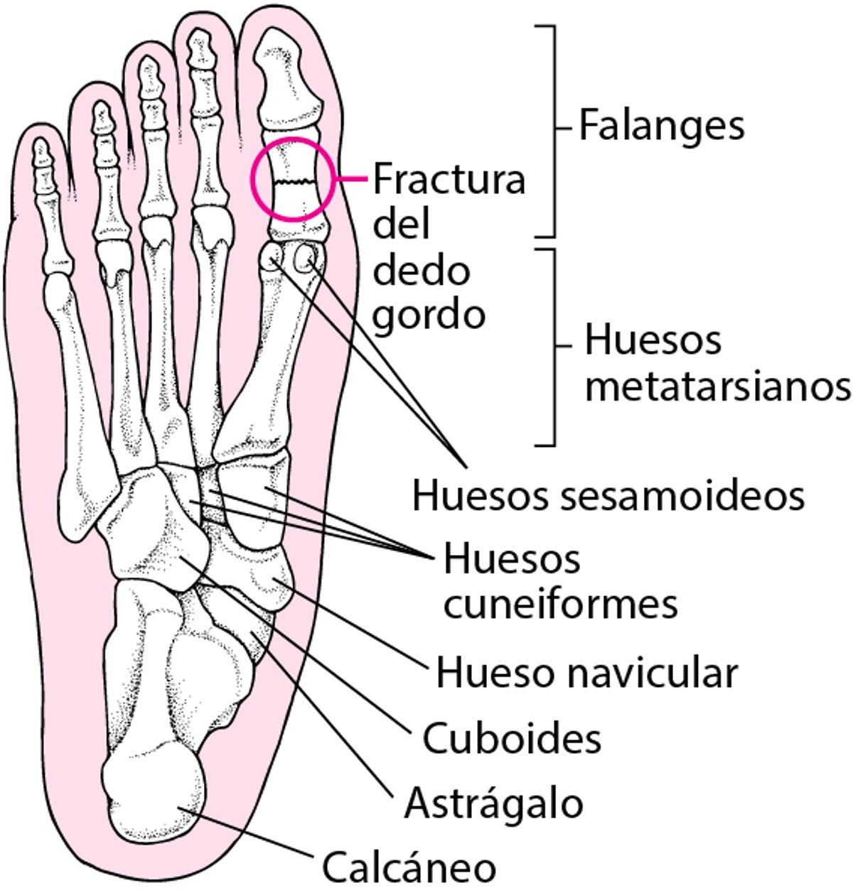 Localización de las fracturas del pie