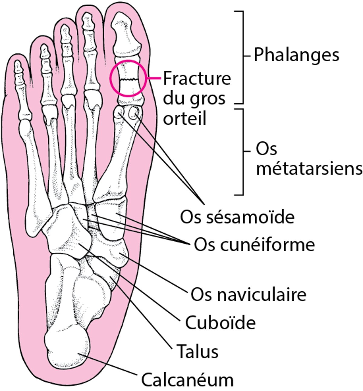 Endroits où surviennent les fractures du pied