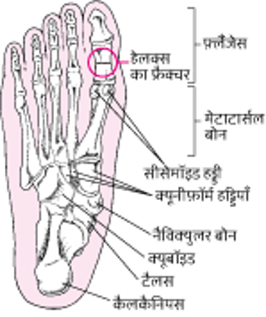 जहाँ पाँव के फ्रैक्चर होते हैं