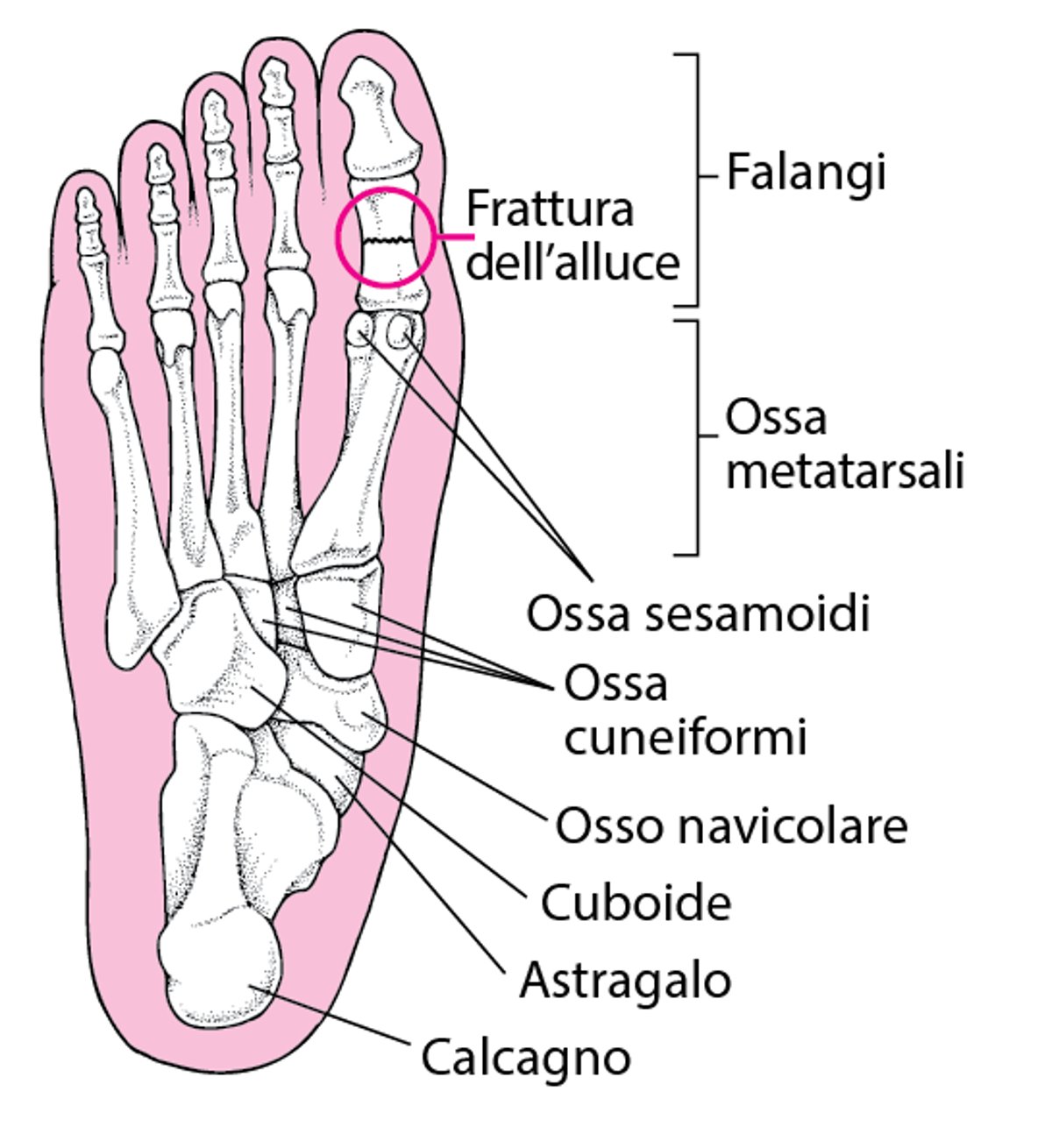 Dove si verificano le fratture del piede