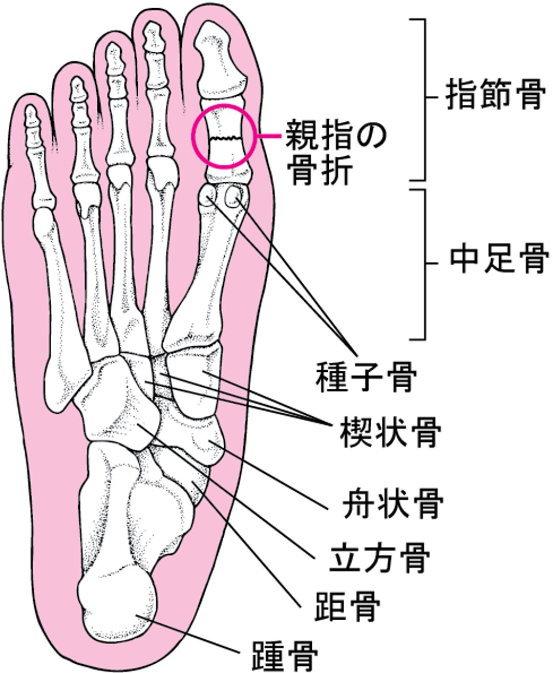 足の骨折が起こる部位