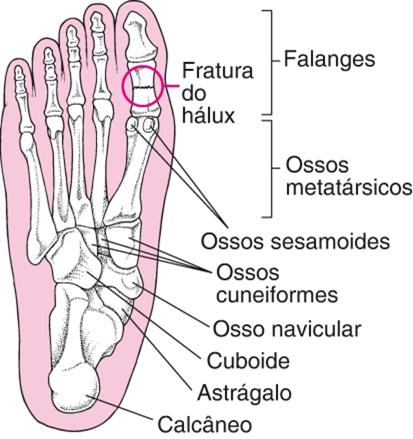 Onde ocorrem fraturas dos pés