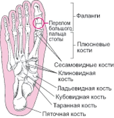 Где происходят переломы костей стопы