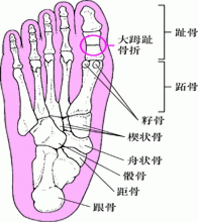 足部骨折发生部位
