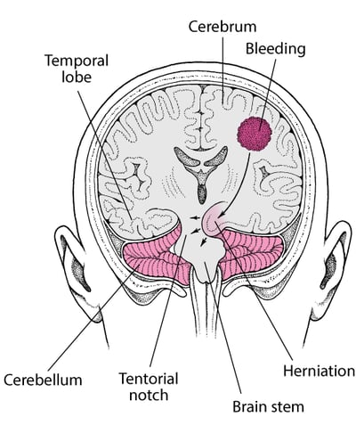 Herniation: The Brain Under Pressure
