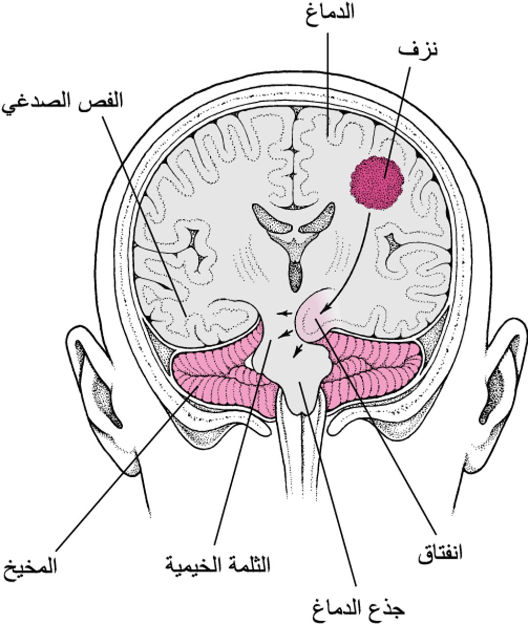 الانفتاق: الدِّماغ تحت الضغط