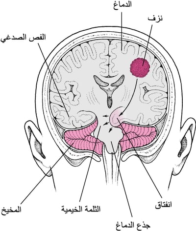 الانفتاق: الدِّماغ تحت الضغط