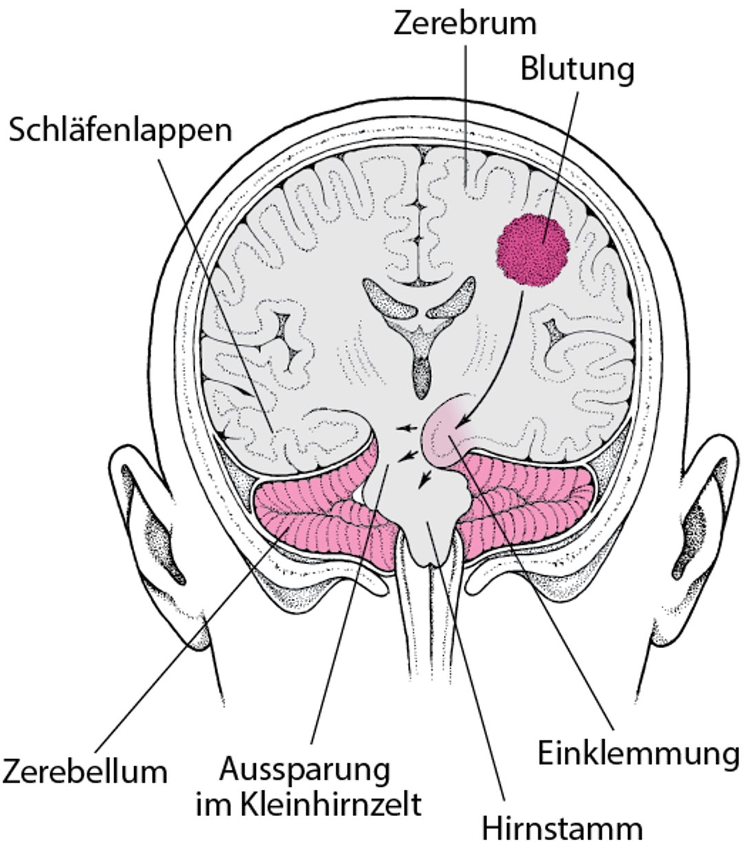 Einklemmung des Gehirns - Einklemmung des Gehirns - MSD Manual Ausgabe ...