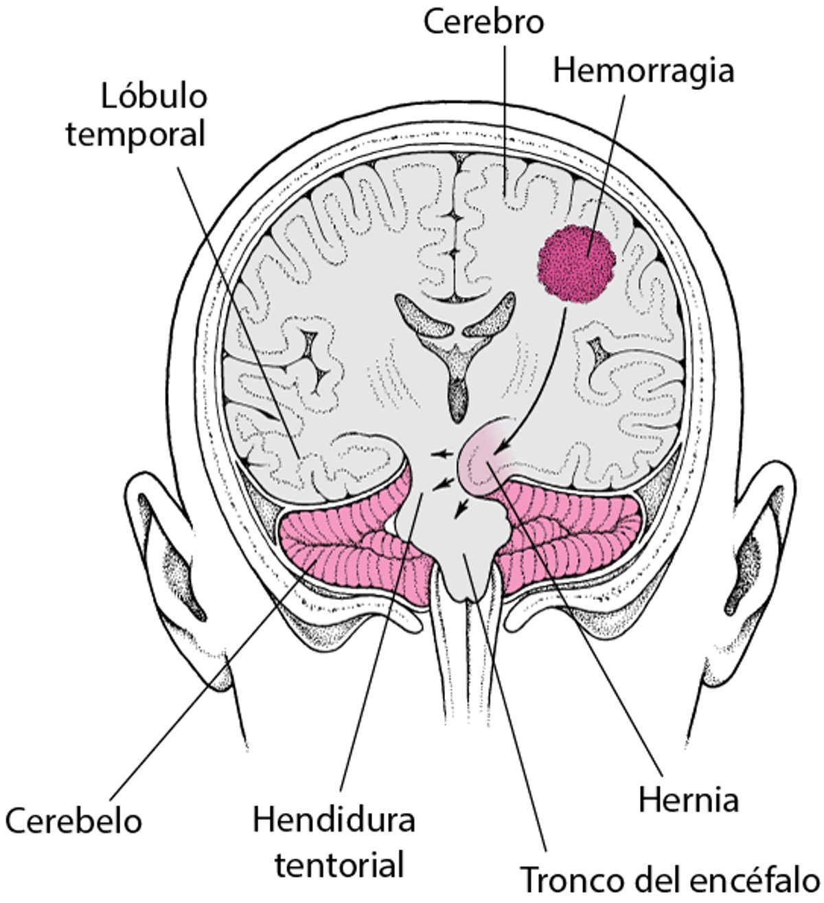Hernia: el encéfalo bajo presión