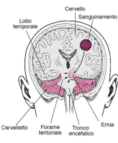 Ernia: il cervello sotto pressione