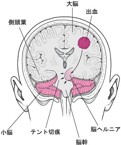 ヘルニア：脳の圧迫