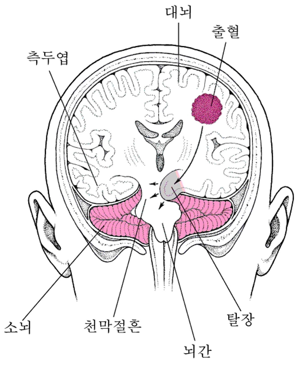 뇌탈출: 압력이 가해진 뇌