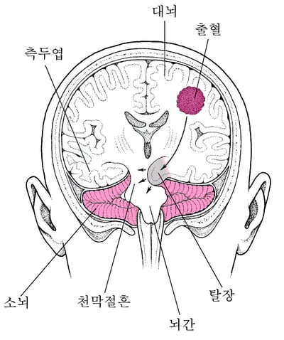 뇌탈출: 압력이 가해진 뇌