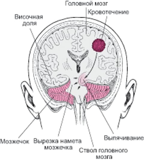 Дислокация: сдавление головного мозга.