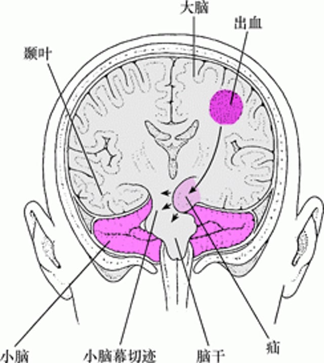 脑疝：受压的脑组织