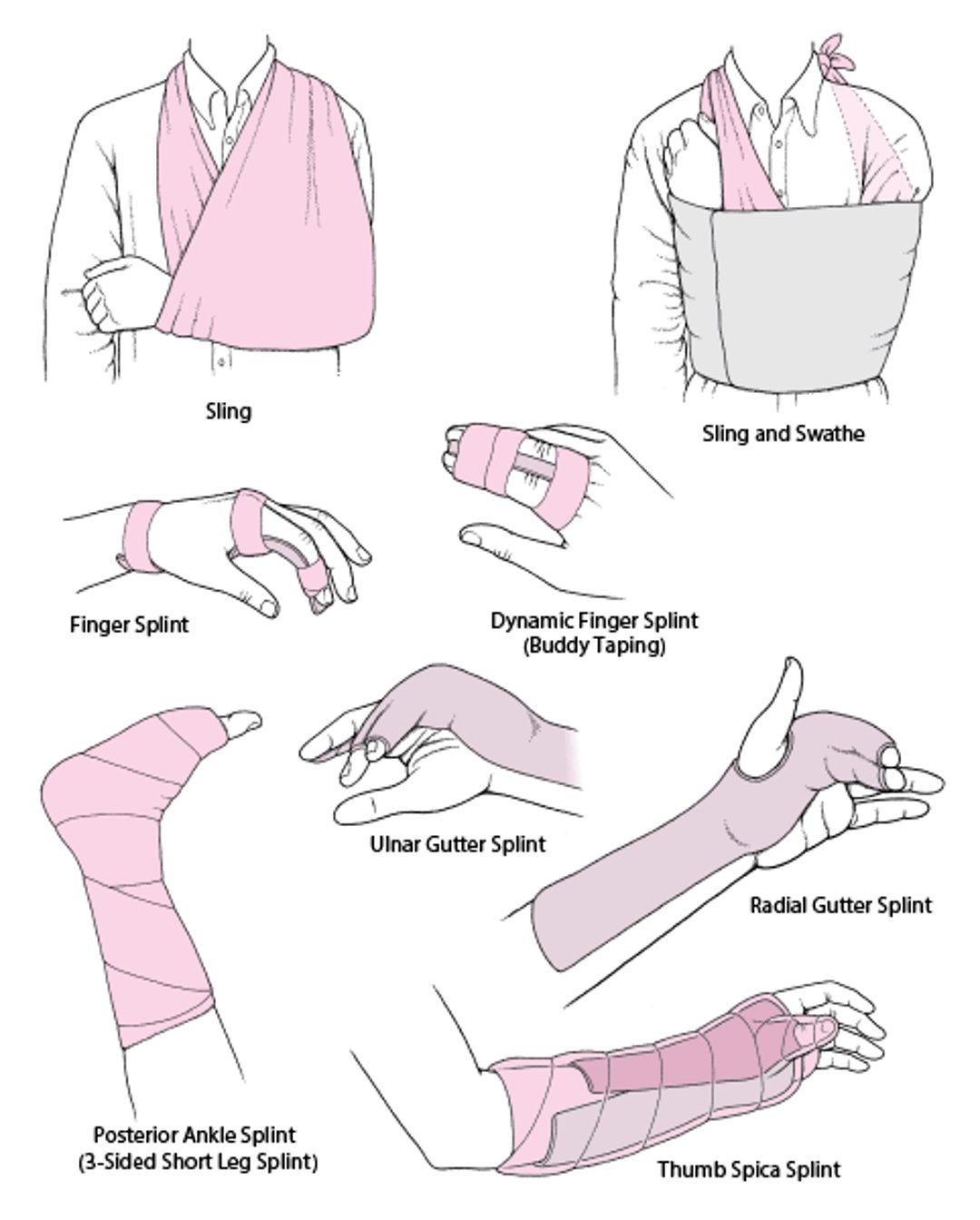 Commonly Used Techniques for Immobilizing a Joint