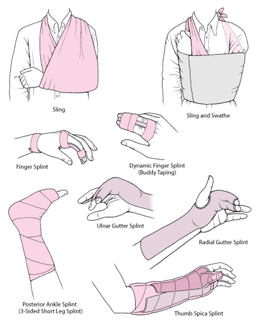 Commonly Used Techniques for Immobilizing a Joint