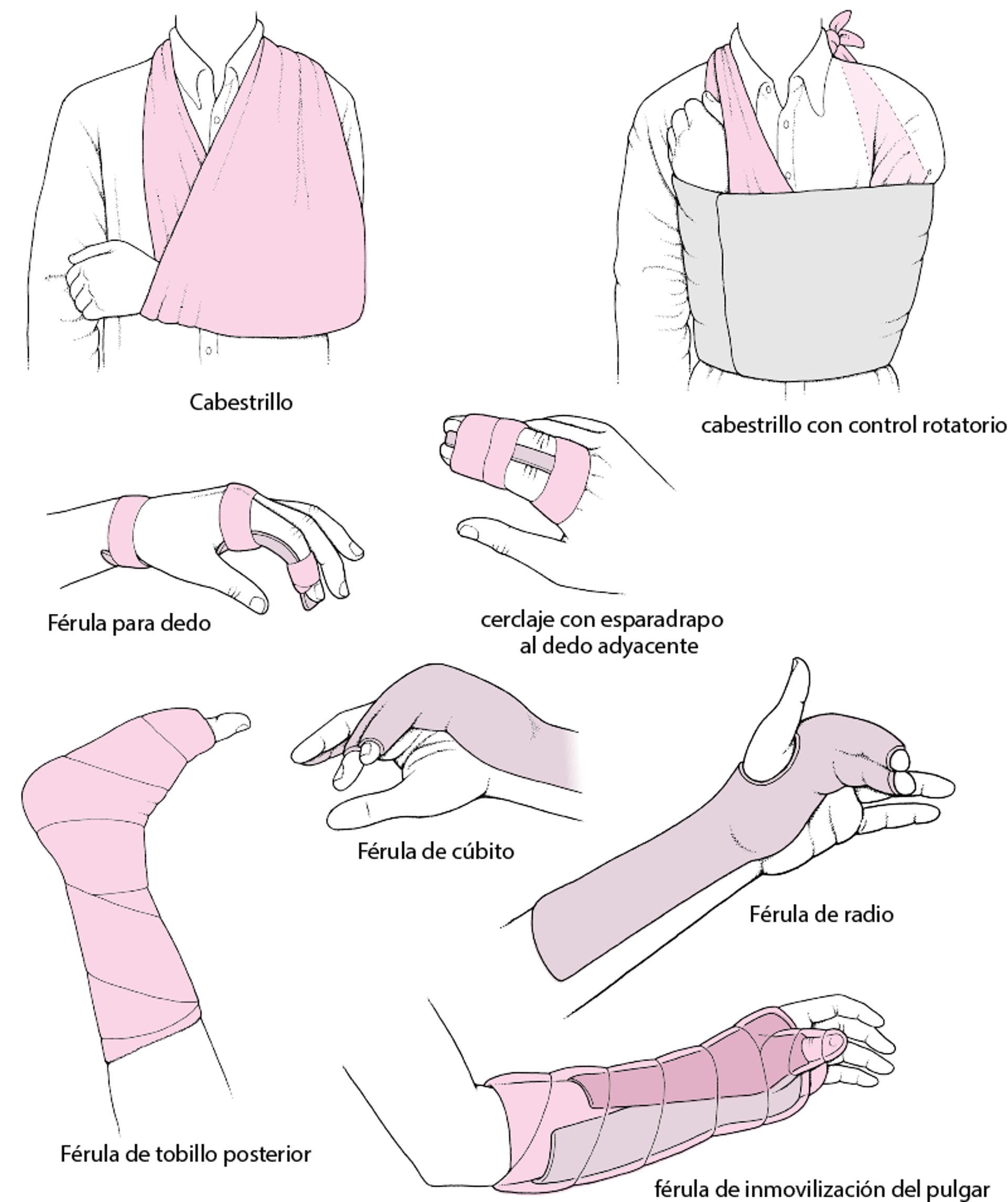 Técnicas habituales para inmovilizar una articulación