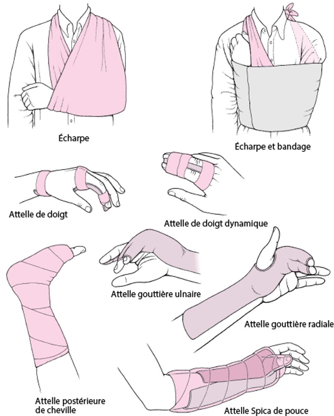 Techniques fréquemment utilisées pour l’immobilisation d’une articulation