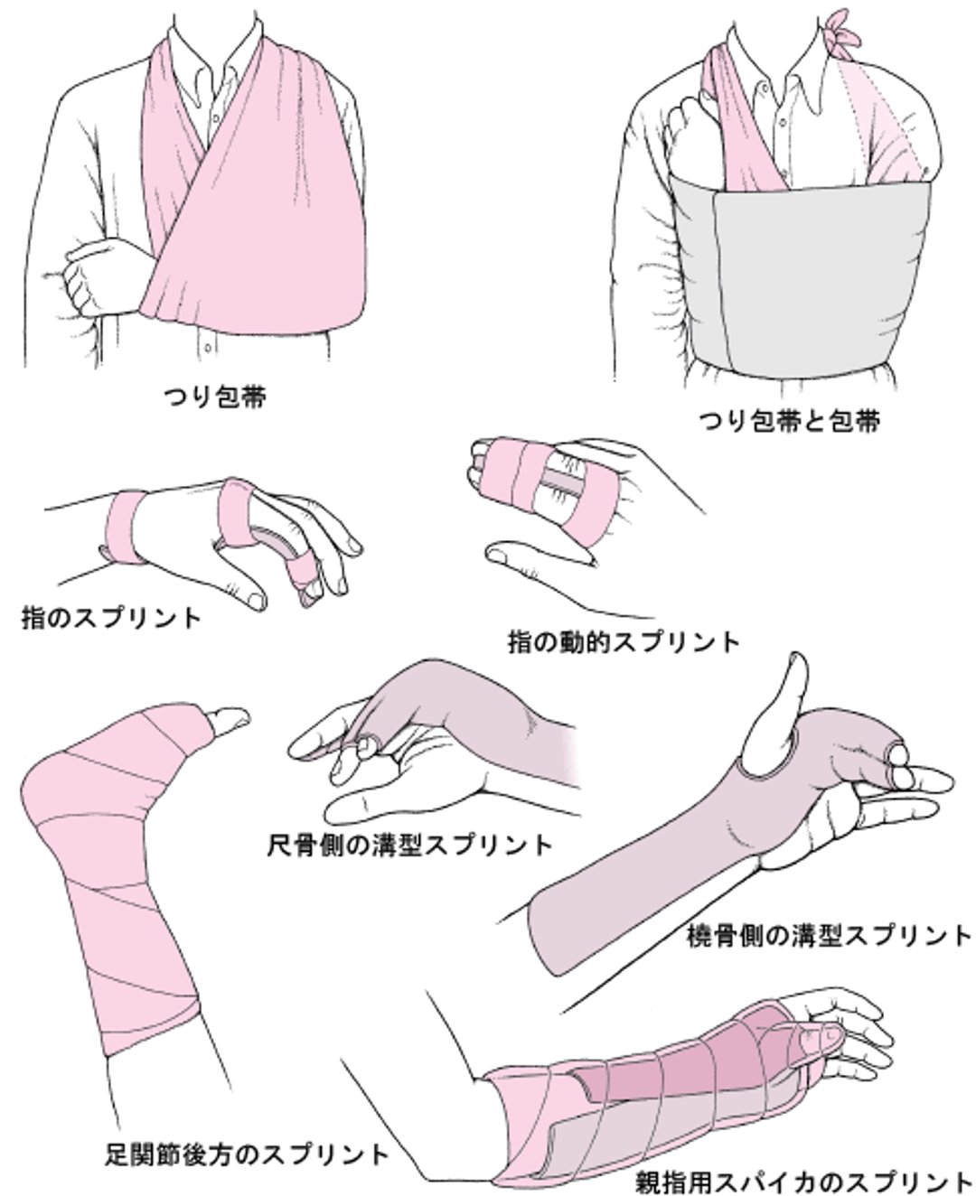 関節固定に用いられる一般的な手法