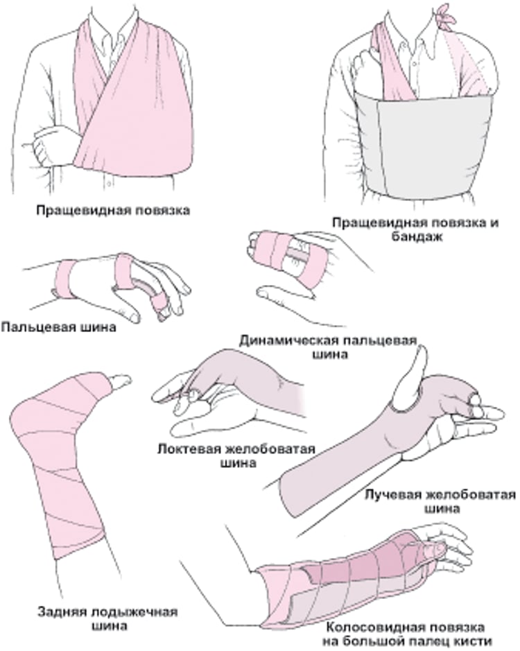 Распространенные способы иммобилизации сустава