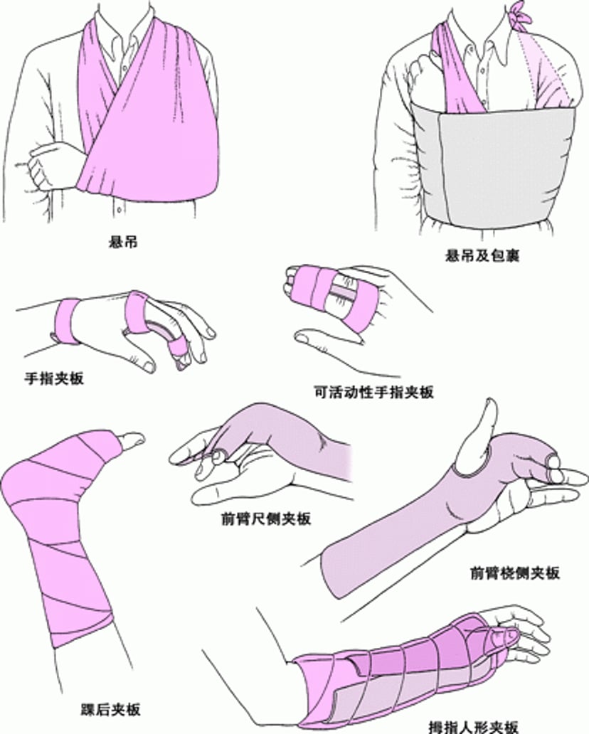 固定关节的常用方法