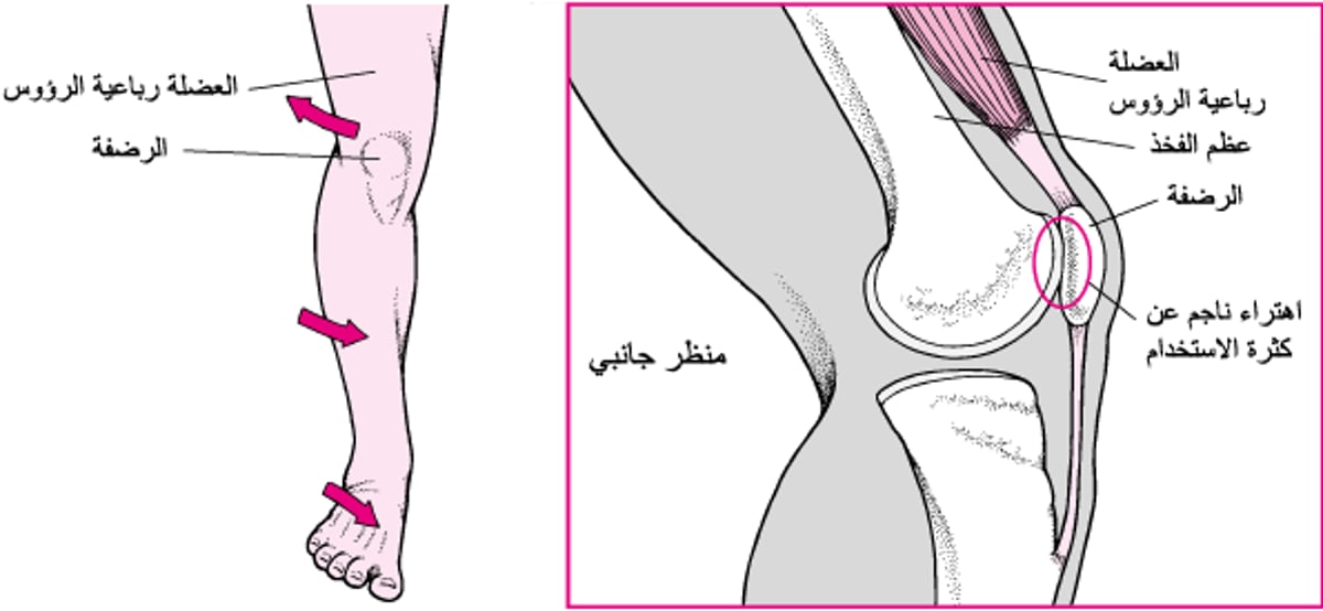عند حدوث إصابة في الجهة الأماميَّة من الرُّكبة