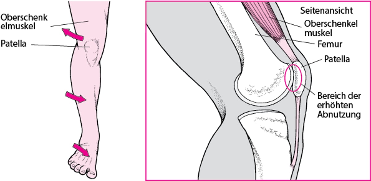 Wenn der vordere Teil des Knies schmerzt
