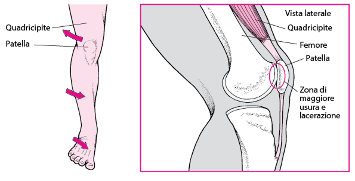 Dolore nella parte anteriore del ginocchio