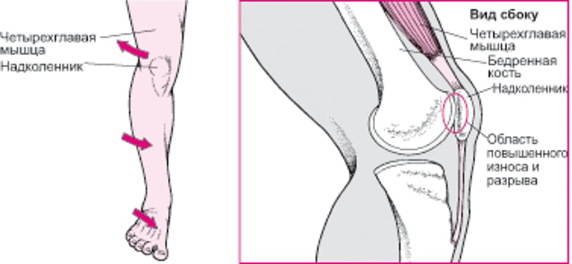 Когда колено болит спереди