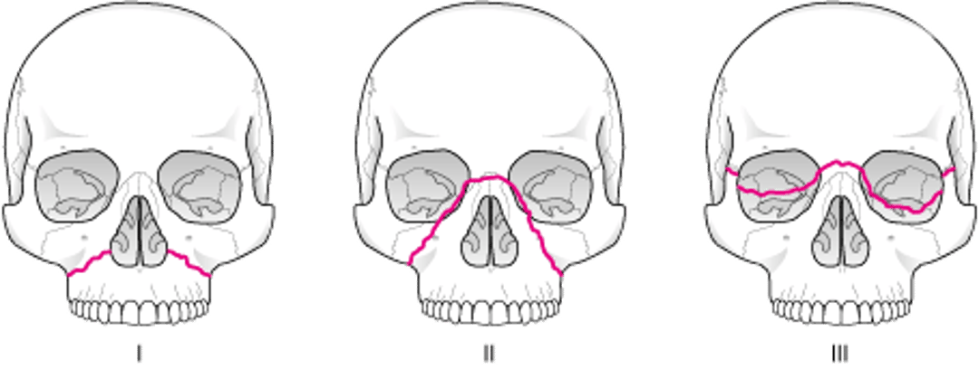 كسورُ مُنتصف الوجه