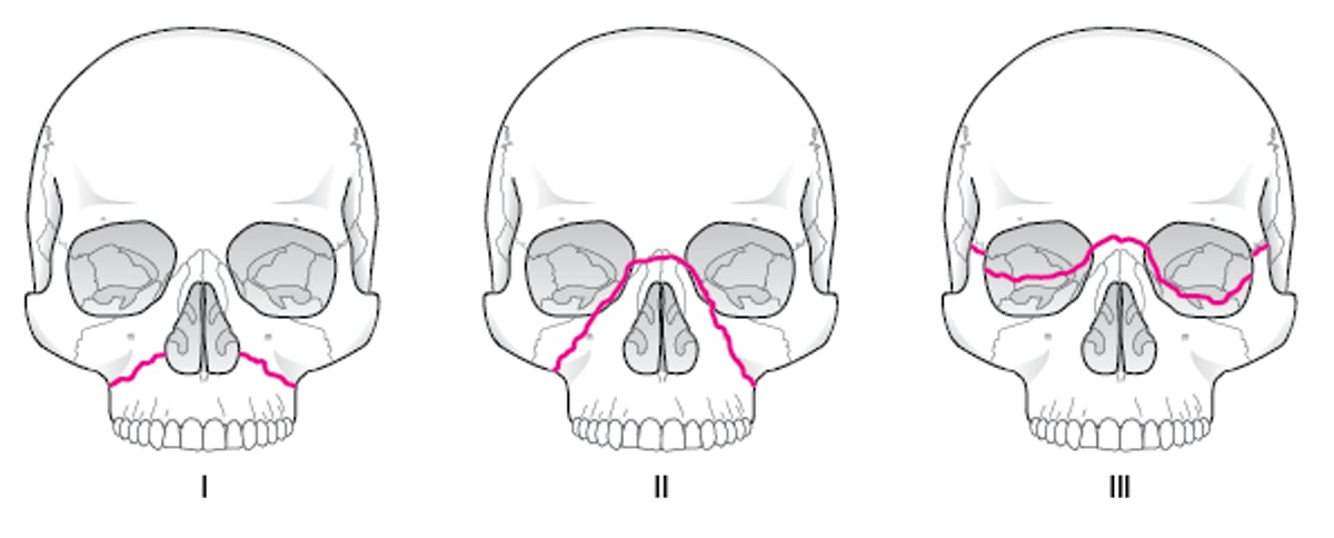 Fratture del massiccio facciale