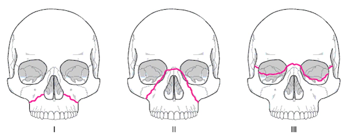 안면중앙부 골절