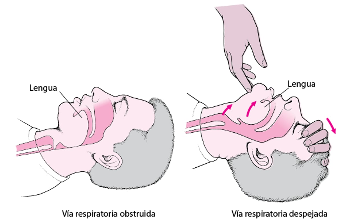 Apertura de una vía aérea en un adulto o un niño
