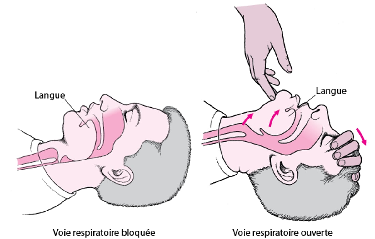 Ouverture des voies respiratoires chez les adultes ou les enfants