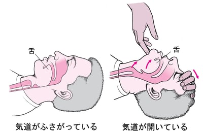 成人または小児における気道の確保