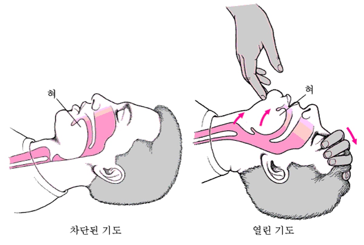 성인 또는 소아의 기도 열기