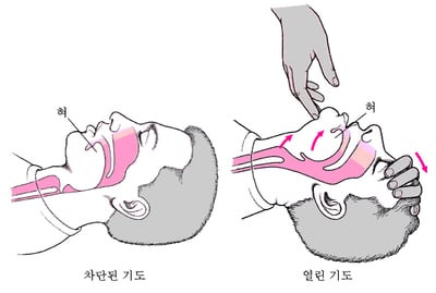 성인 또는 소아의 기도 열기