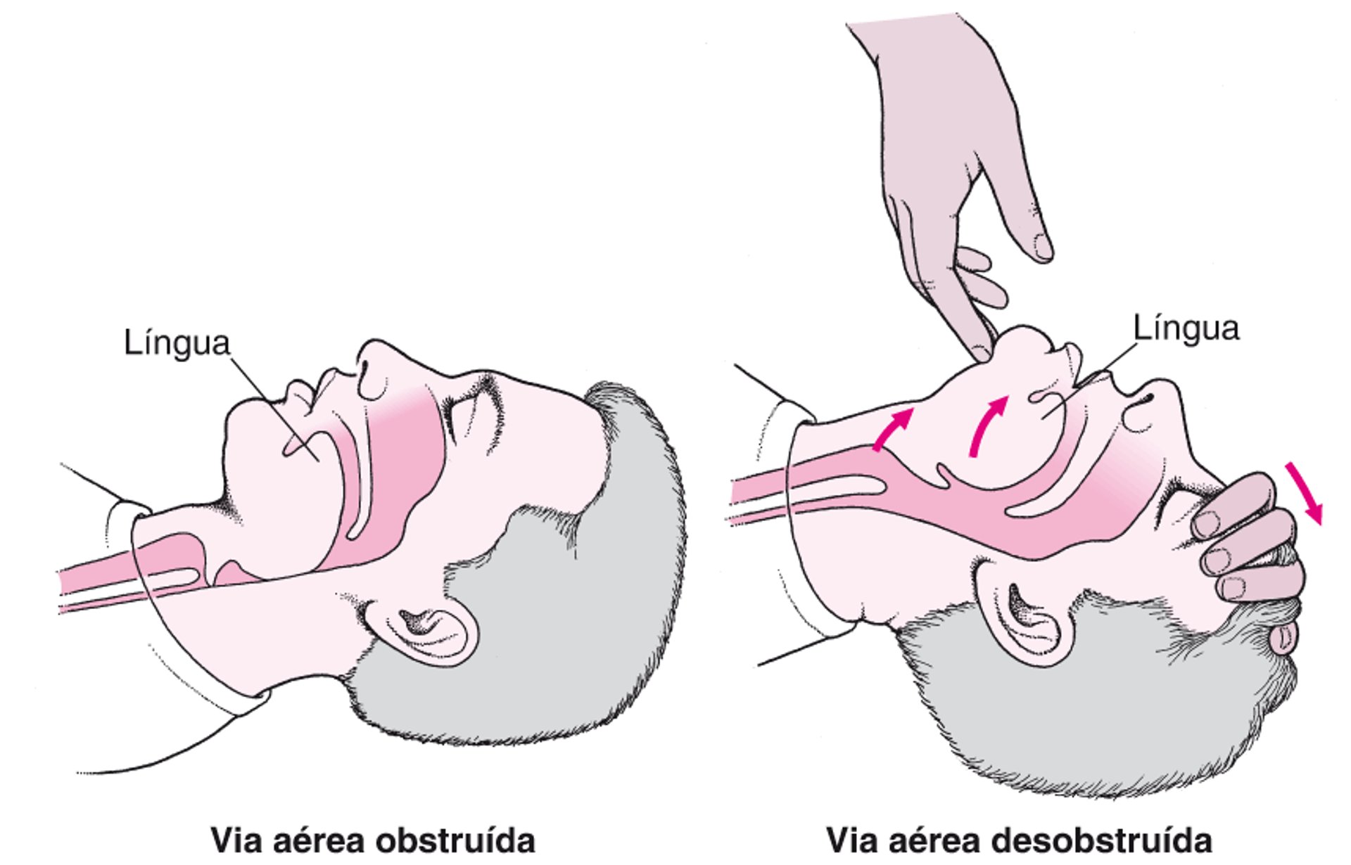 Abrindo as vias respiratórias em um adulto ou uma criança