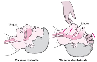 Abrindo as vias respiratórias em um adulto ou uma criança