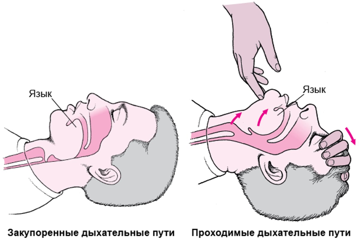 Открытие дыхательных путей у взрослых или детей