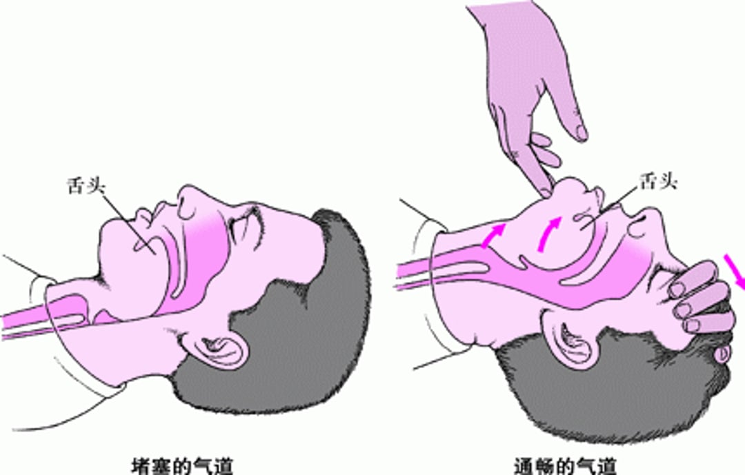 开放成人或儿童的气道