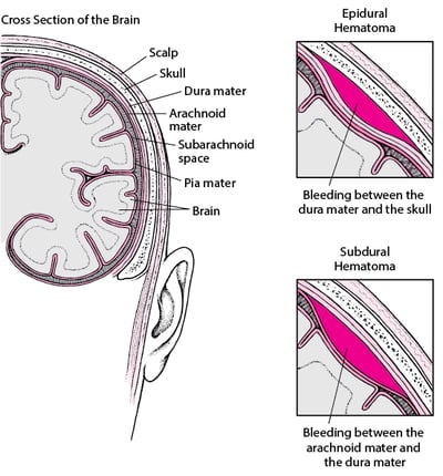 Pockets of Blood in the Brain