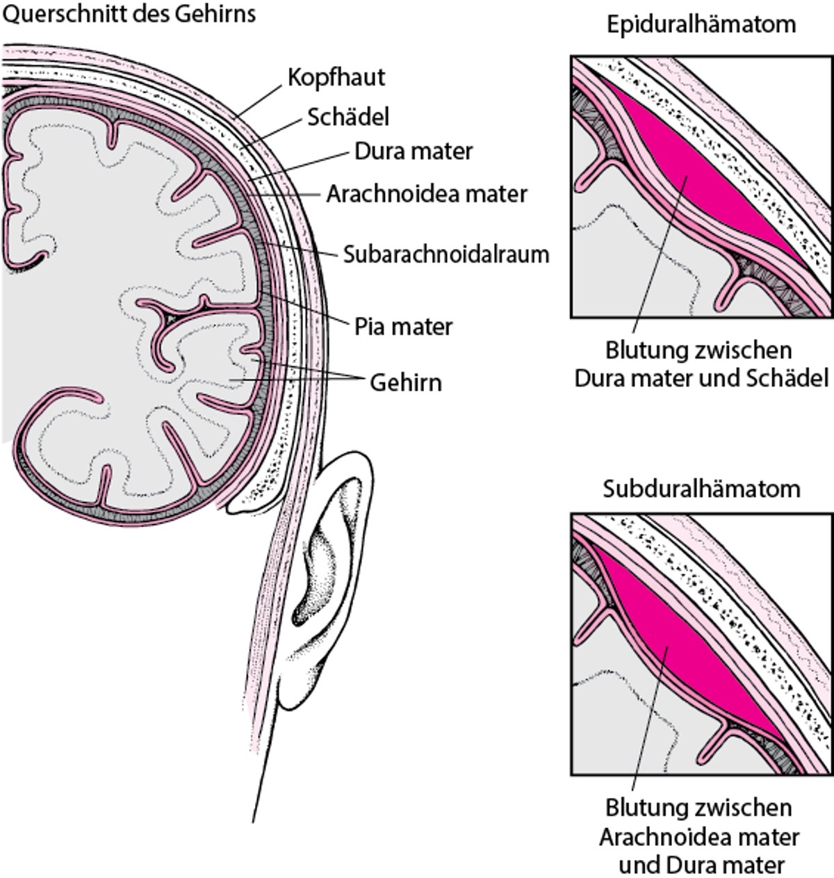 Blutansammlungen im Gehirn